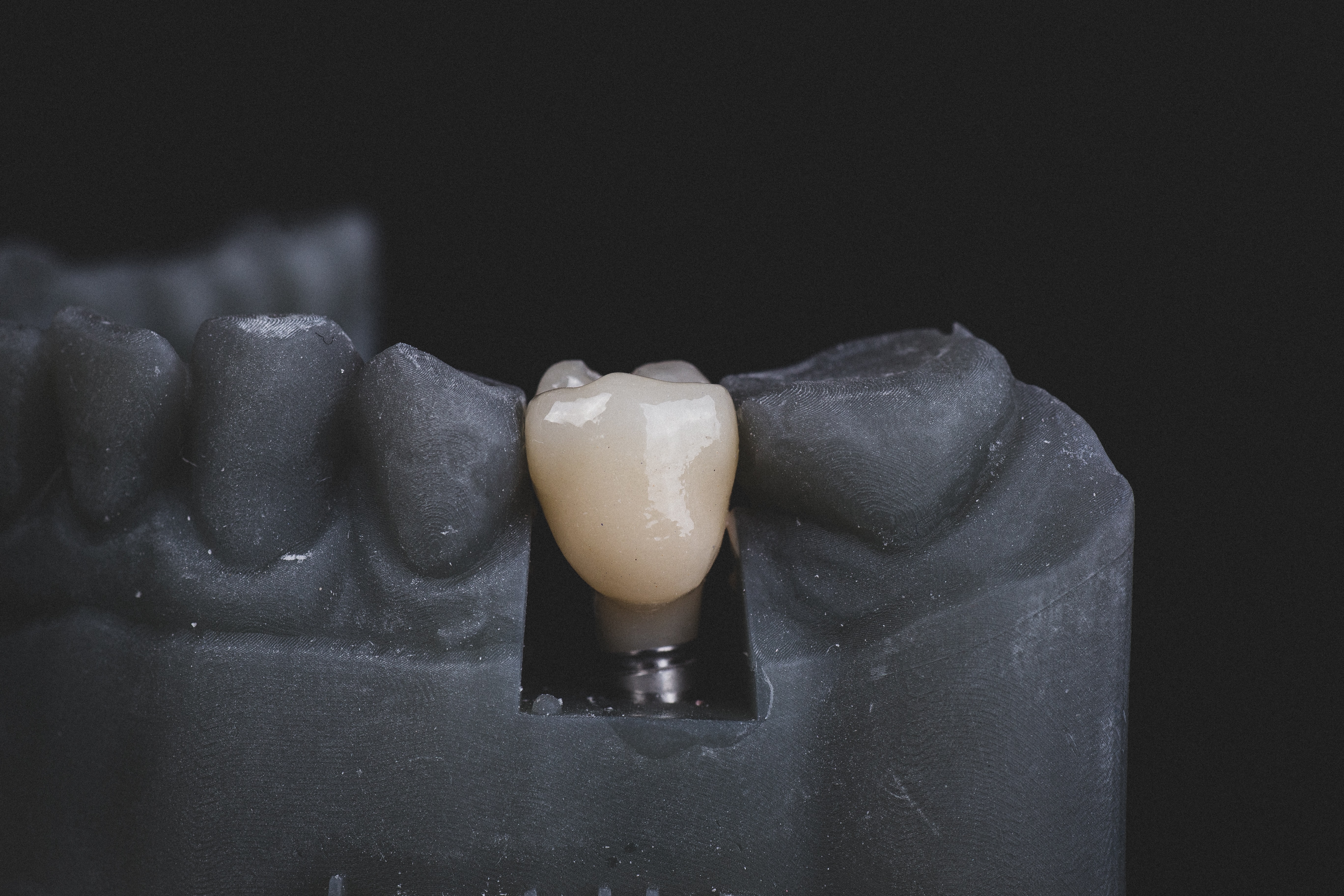 Things to Know About Dental Implants